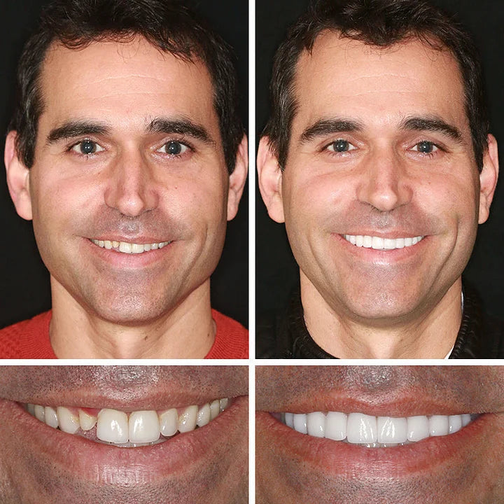 ⚡ Ends Today: 50% OFF! Smile More Comfortably Again